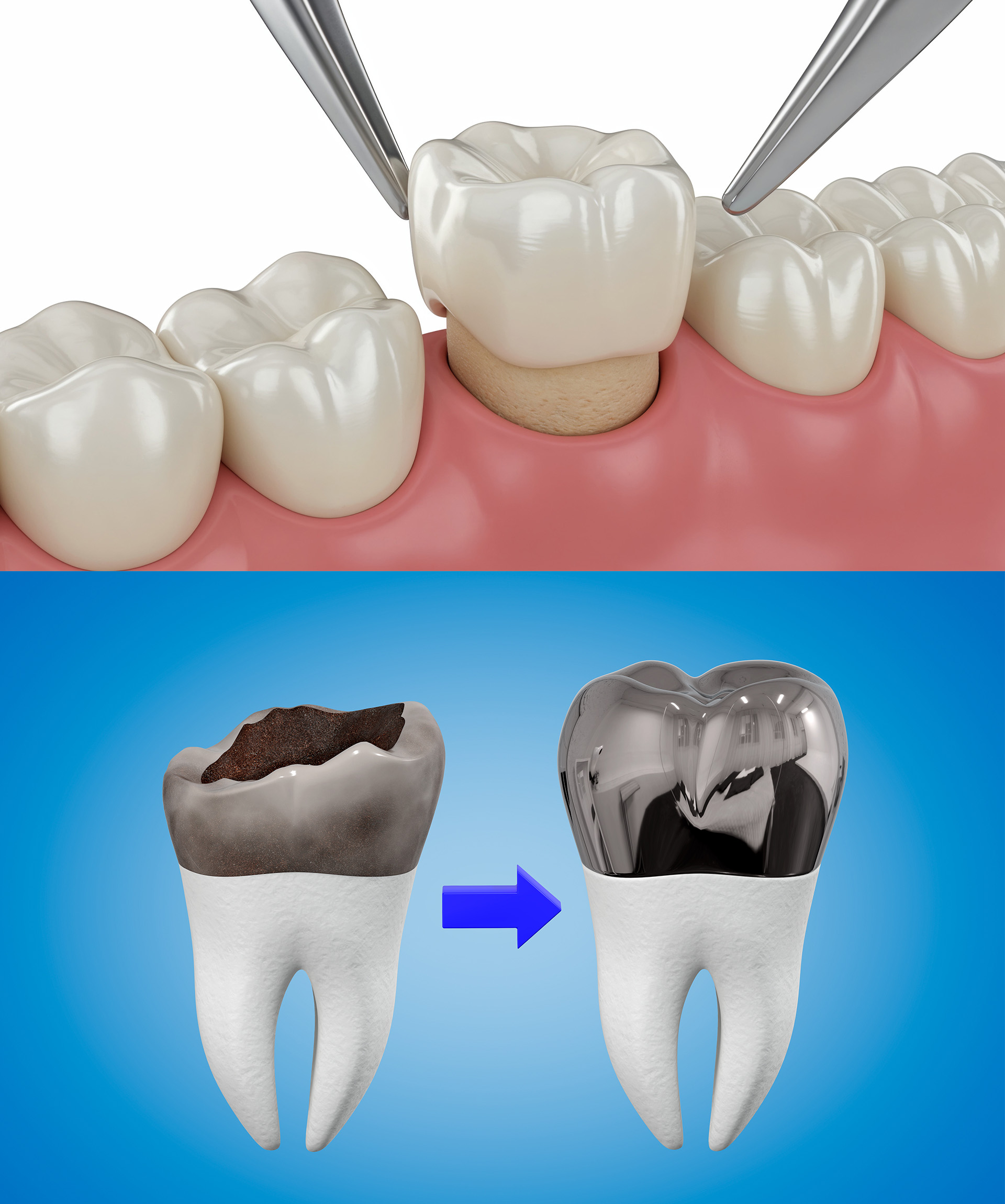 Childrens Dental Crowns Dentist Near You